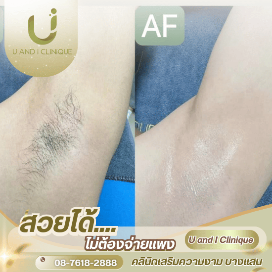 คลินิกเลเซอร์ขนรักแร้ บางแสน ศรีราชา ชลบุรี - คลินิกเสริมความงาม บางแสน - ยูแอนด์ไอ คลินิก