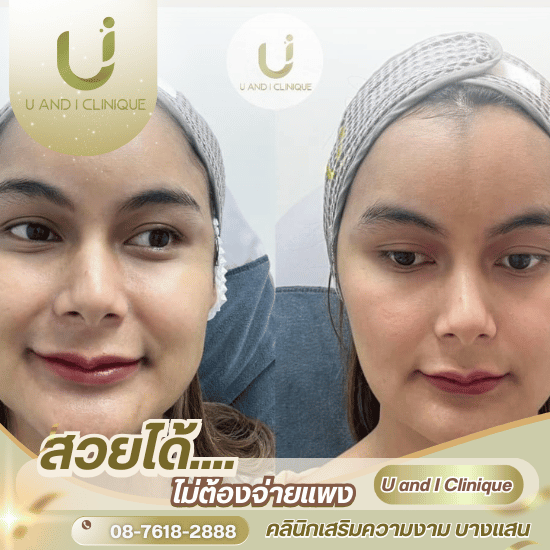 ฉีดโบลดกราม ชลบุรี - คลินิกเสริมความงาม บางแสน - ยูแอนด์ไอ คลินิก