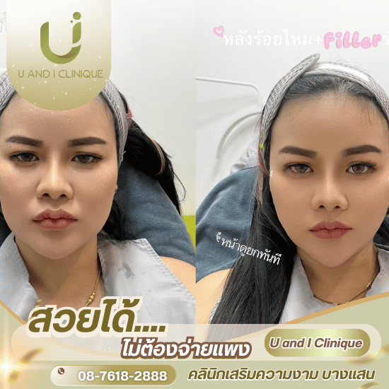 คลินิกร้อยไหมใกล้ฉัน บางแสน ศรีราชา ชลบุรี - คลินิกเสริมความงาม บางแสน - ยูแอนด์ไอ คลินิก