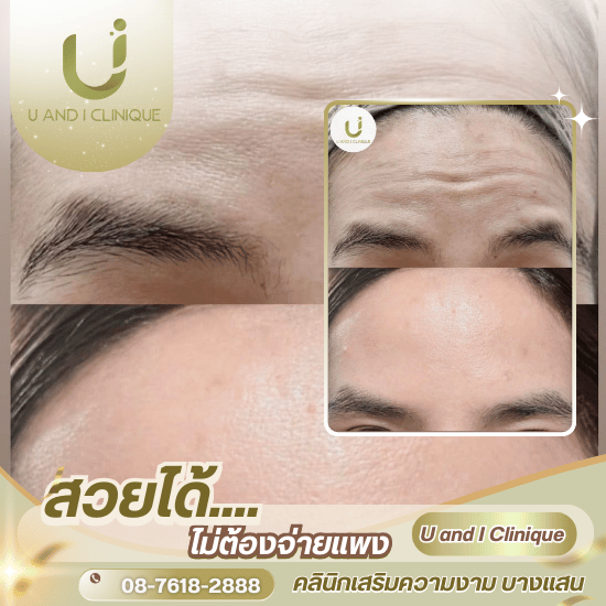 ฉีดโบลดริ้วรอย ชลบุรี - คลินิกเสริมความงาม บางแสน - ยูแอนด์ไอ คลินิก ฉีดโบลดริ้วรอย ชลบุรี - คลินิกเสริมความงาม บางแสน - ยูแอนด์ไอ คลินิก