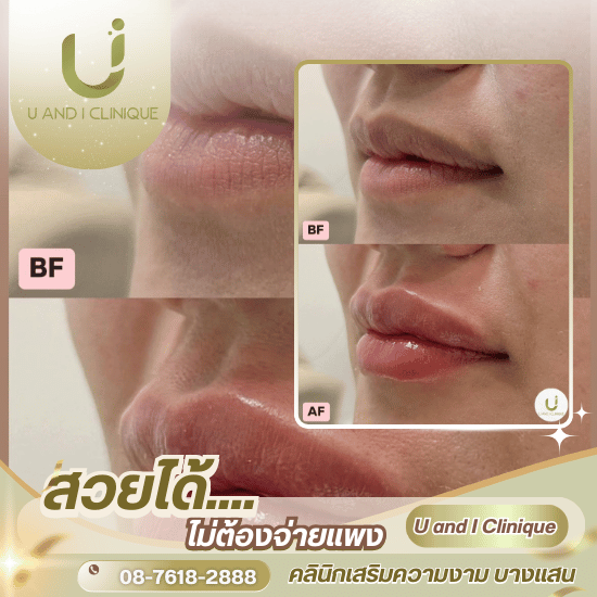 ฉีดฟิลเลอร์ปาก บางแสน ศรีราชา ชลบุรี - คลินิกเสริมความงาม บางแสน - ยูแอนด์ไอ คลินิก