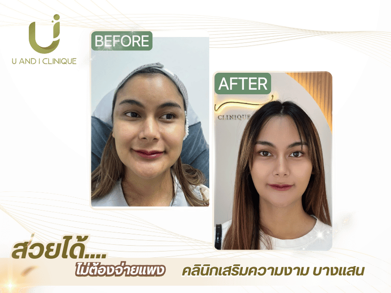 คลินิกฉีดโบท็อกซ์ ใกล้ฉัน บางแสน-ศรีราชา ชลบุรี คลินิกฉีดโบท็อกซ์ ใกล้ฉัน บางแสน-ศรีราชา ชลบุรี