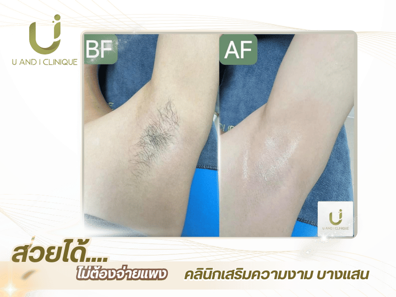คลินิกเลเซอร์กำจัดขนใกล้ฉัน บางแสน-ศรีราชา ชลบุรี คลินิกเลเซอร์กำจัดขนใกล้ฉัน บางแสน-ศรีราชา ชลบุรี